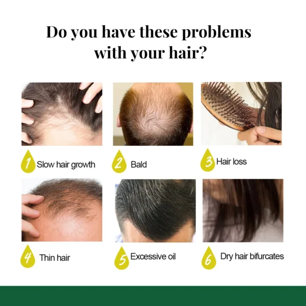 Antiloss Ginger Hair Growth Essential Oil Hair Regrowth Serum Fast Growth Prevent Baldness Treatment Alopecia Hair Care Product - Image 3